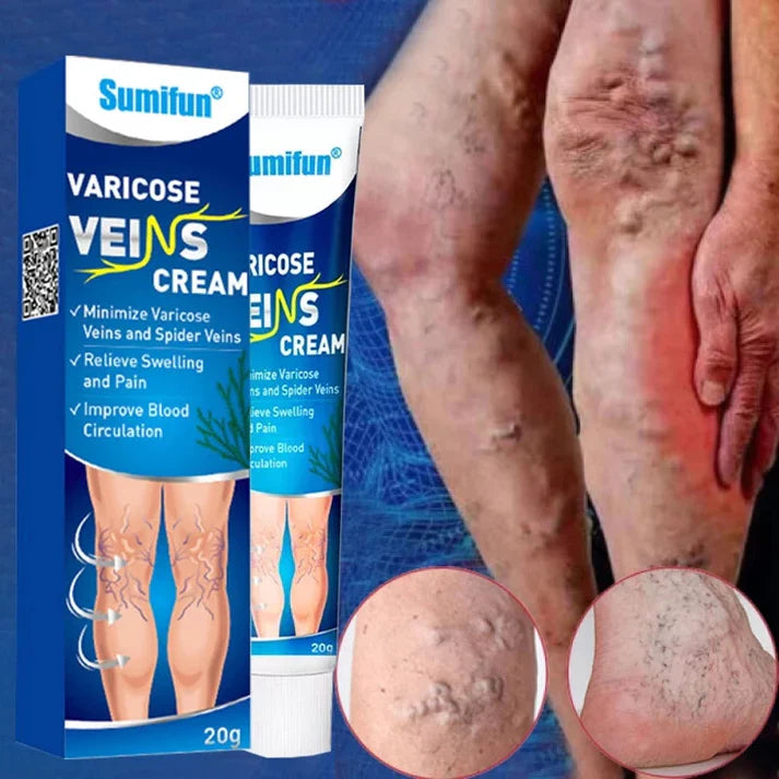 Varicose Vein Cream